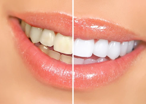تصویر چسب سفید کننده دندان 