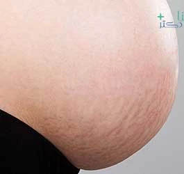تصویر رفع سلولیت و ترک چاقی و حاملگی 